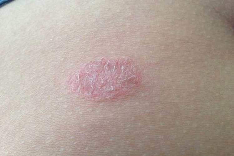 玫瑰糠疹鳞屑性斑图