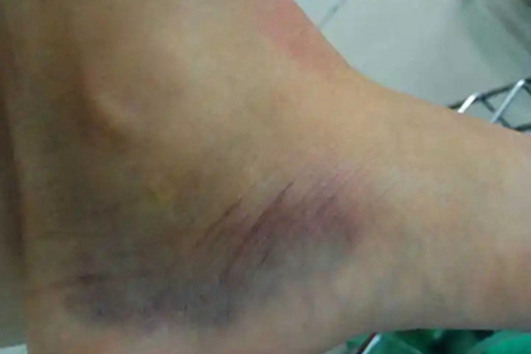 瘀斑脚部片状发青图 瘀斑脚部片状发青图