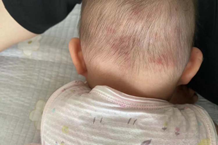 亚急性湿疹后脑勺有红斑图