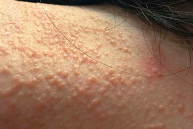 汗腺瘤颈部密密麻麻丘疹图