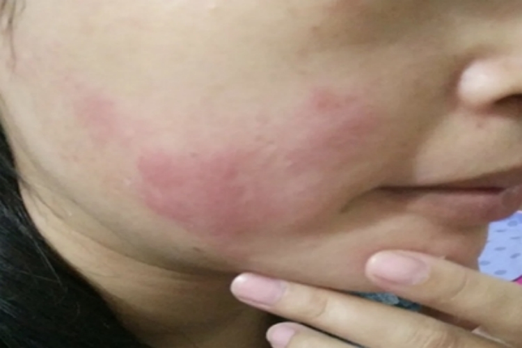 海鲜过敏面部全是红斑图