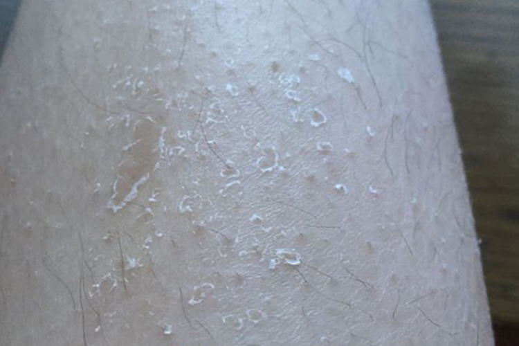 皮肤干燥症大腿起皮屑图 皮肤干燥症大腿起皮屑图