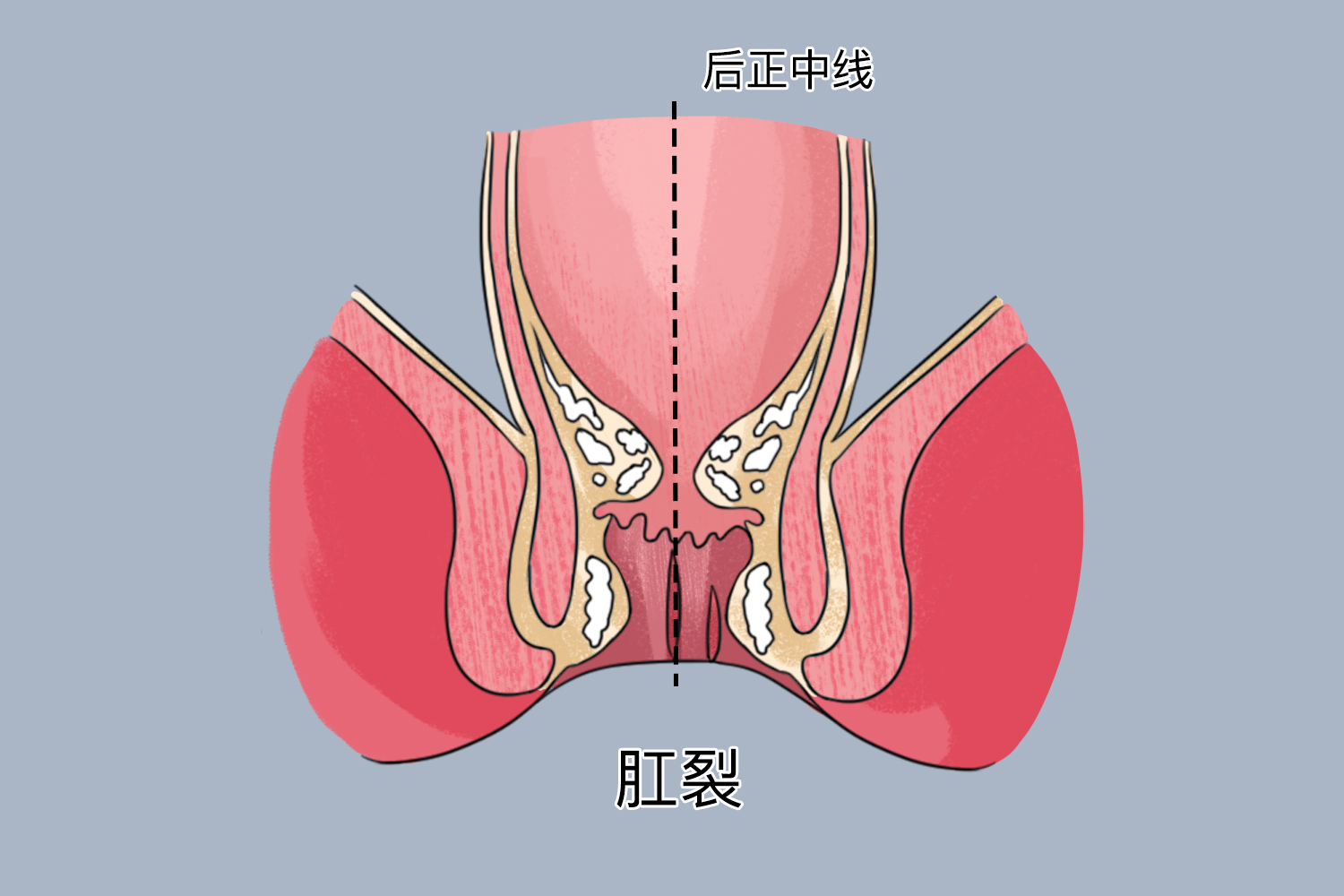 肛裂在什么位置图片图片