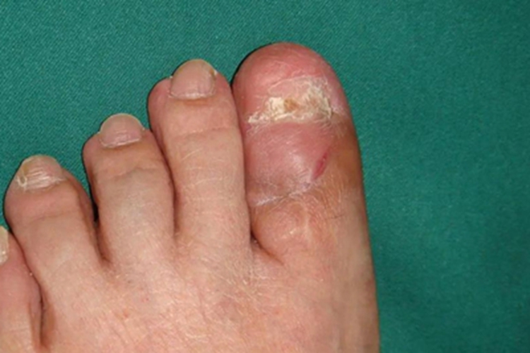 黏液样囊肿脚趾症状图