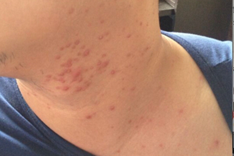 马拉色菌毛囊炎前颈症状图