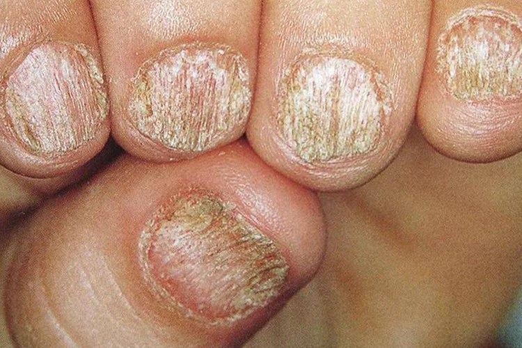 甲营养不良指甲盖分层脱落图 甲营养不良指甲盖分层脱落图