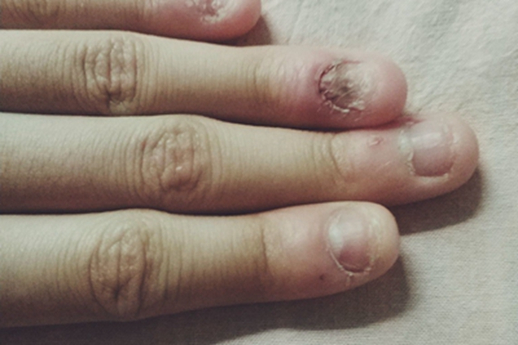 咬甲癖手指甲缩小图