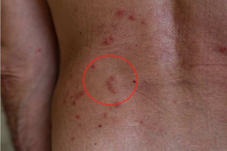 过敏红色丘疹图