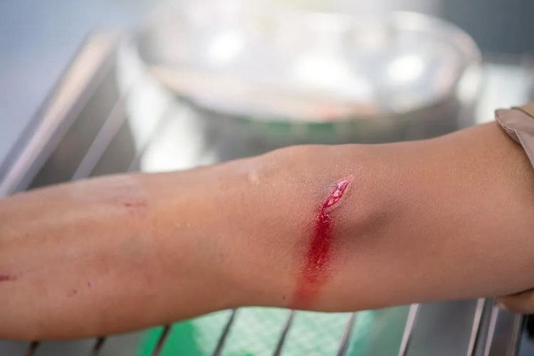 撕裂伤开放性伤口图 撕裂伤开放性伤口图