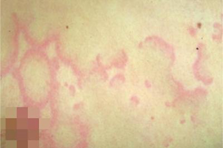 风湿性环状红斑症状图