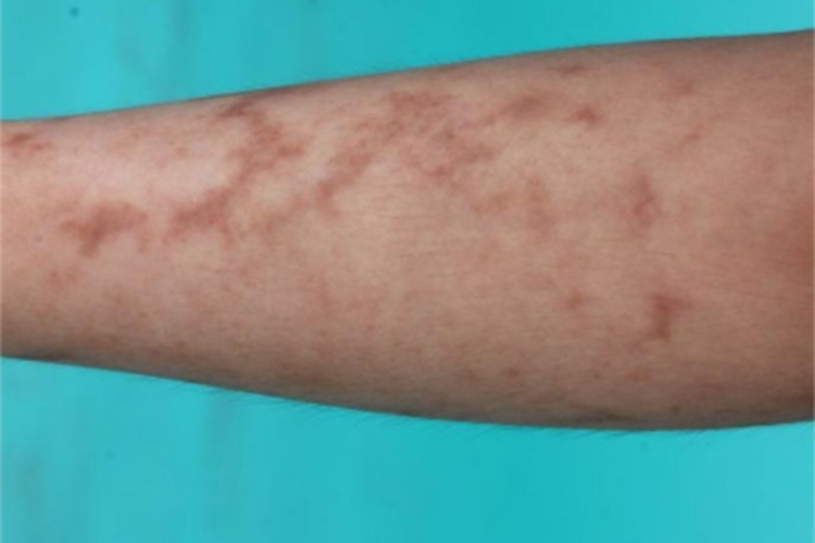 网状肢端色素沉着纹图