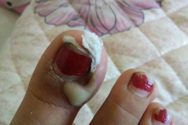 嵌甲大脚趾鼓起个脓包图