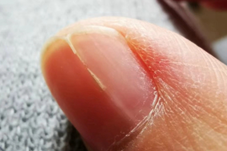 甲纵裂大拇指指甲裂开发白图