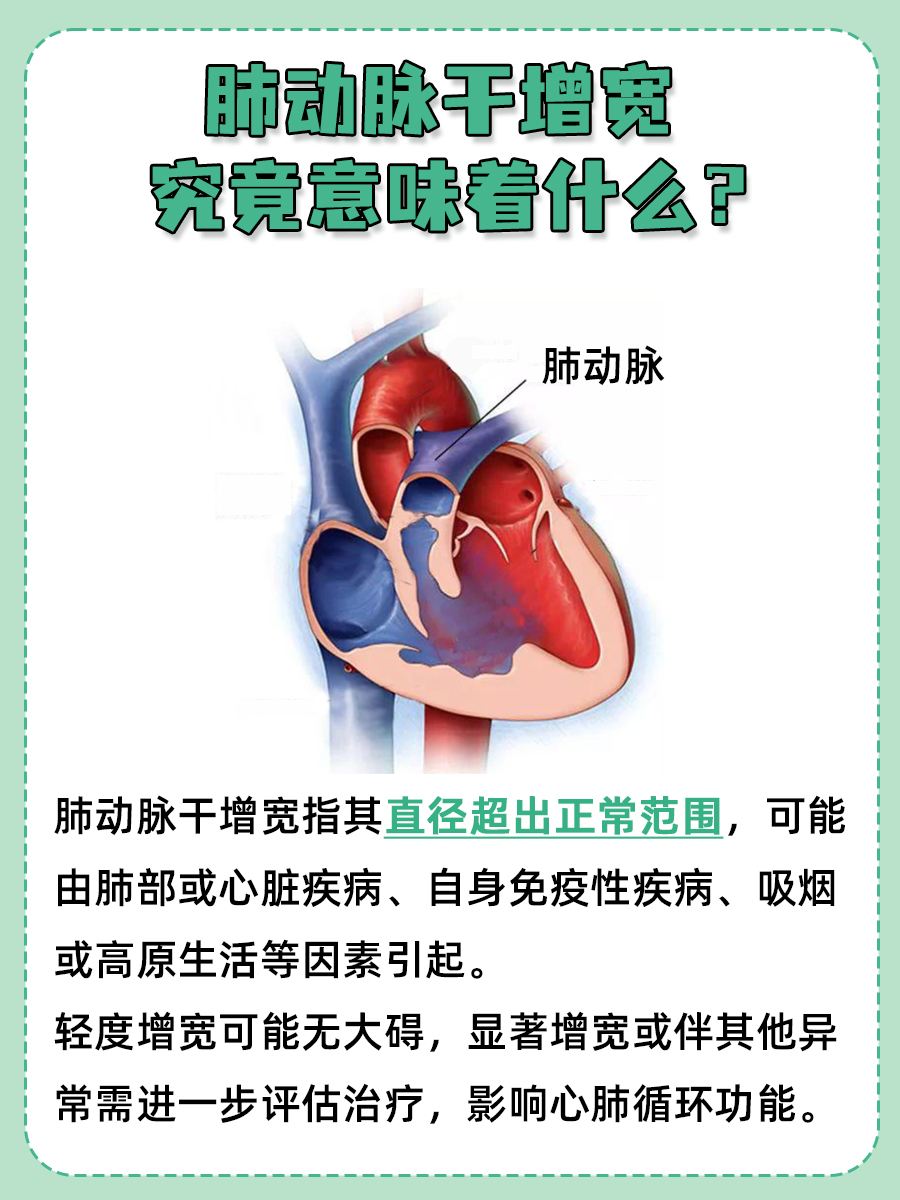 肺动脉干增宽，究竟意味着什么？