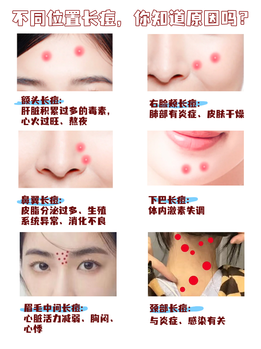 痘痘位置告诉你：身体哪里出了问题？一图读懂！