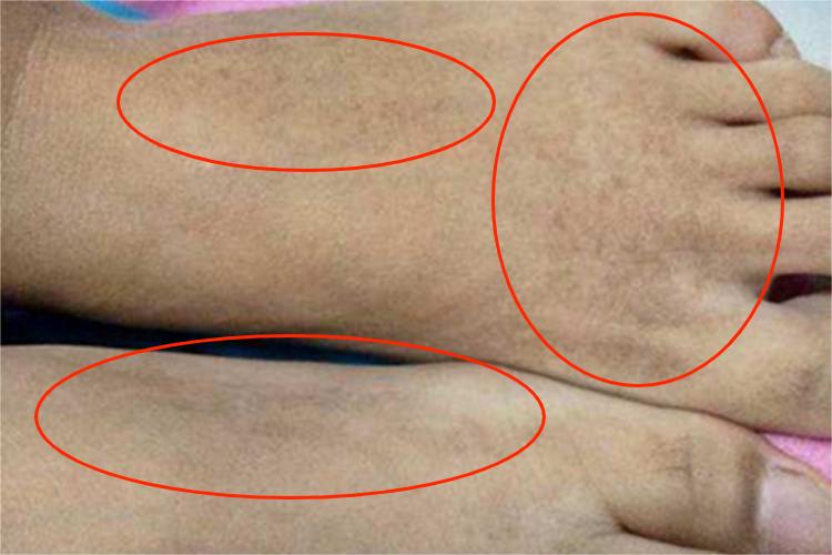 柯萨奇湿疹脚背斑图