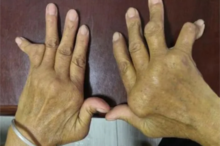 氟骨症手指畸形图