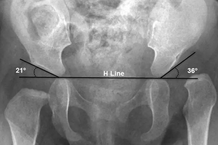 髋关节发育不良图