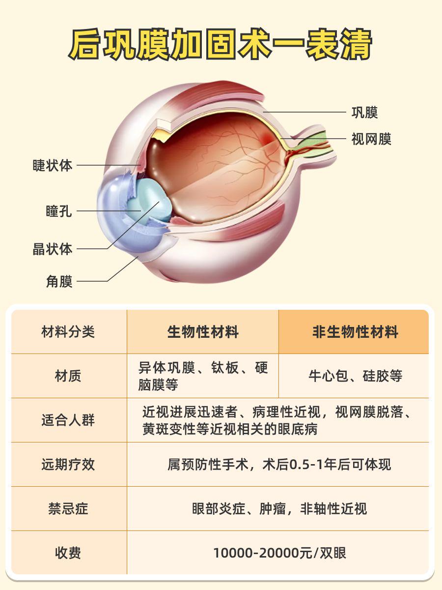 北京后巩膜加固术攻略：从医院选择到术后护理的完整指南