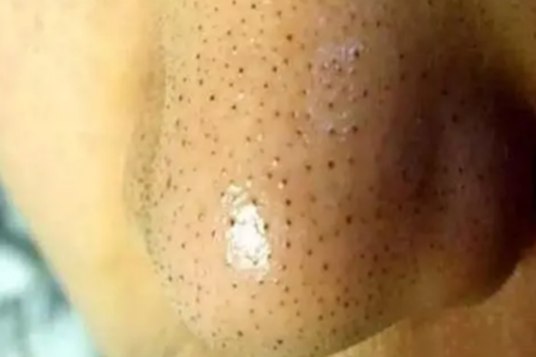 小棘毛壅病鼻尖丘疹图