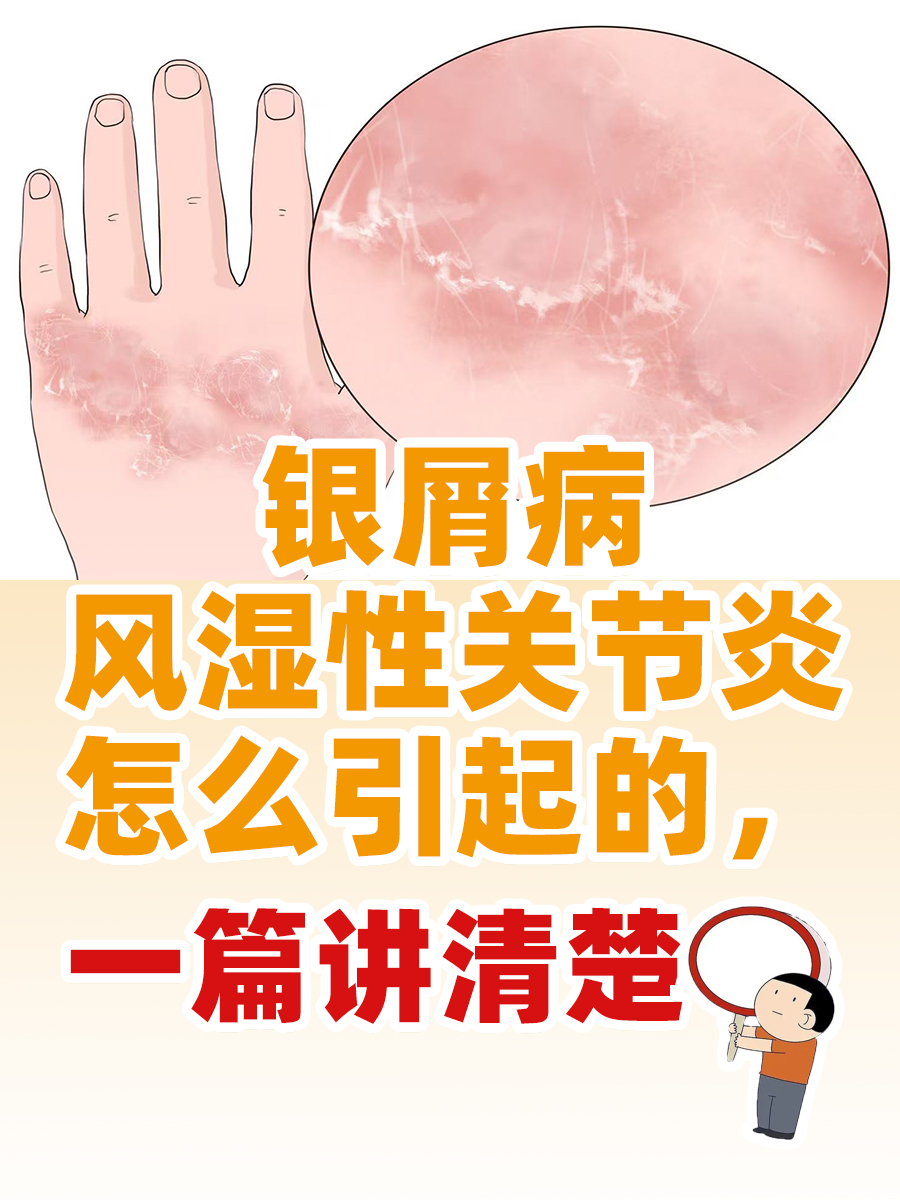 银屑病风湿性关节炎怎么引起的，一篇讲清楚