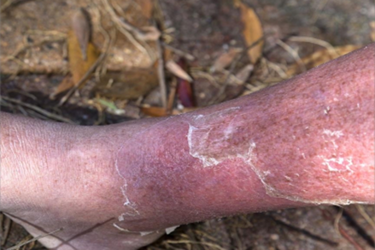 蜂窝织炎小腿红肿脱皮图 蜂窝织炎小腿红肿脱皮图