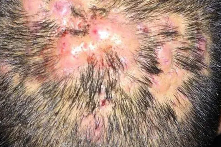 老年人头上长疖肿图