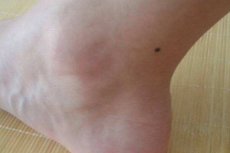 交界痣脚踝症状图