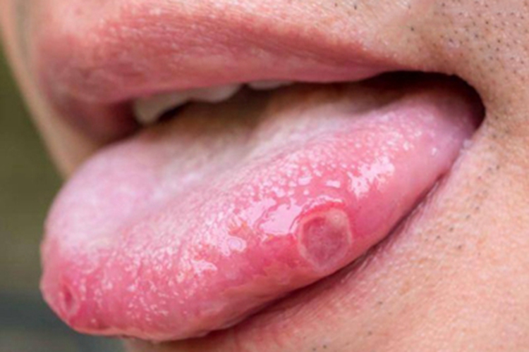 舌癌舌头侧边有个溃疡图