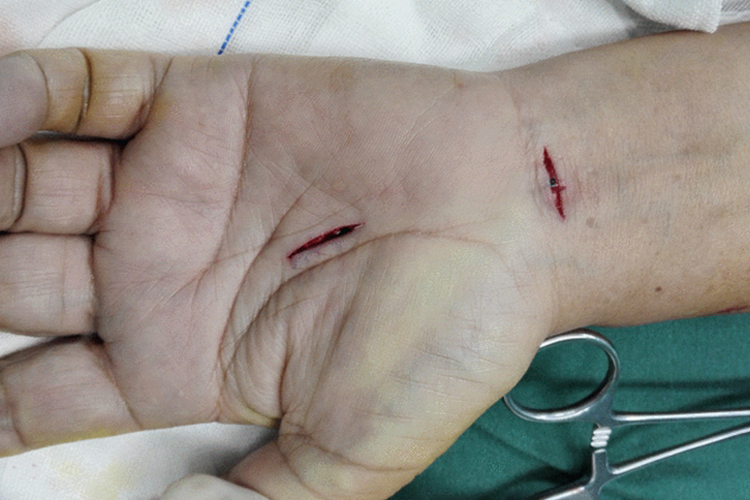 腕管综合征手术切口图