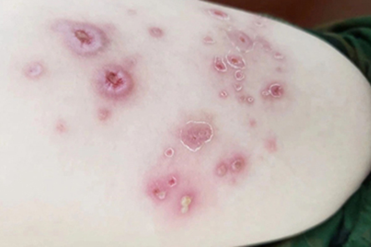 脓疱疮胳膊红斑图