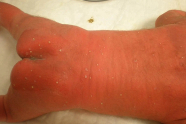 新生儿脓疱疮全身症状图