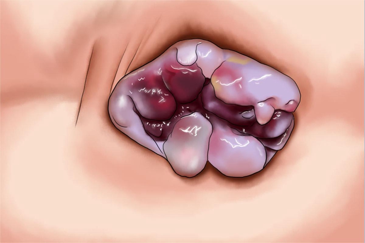 Ⅳ度内痔肛门症状手绘图