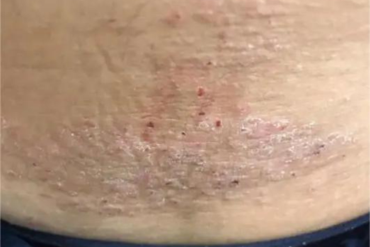 慢性湿疹腰部症状图