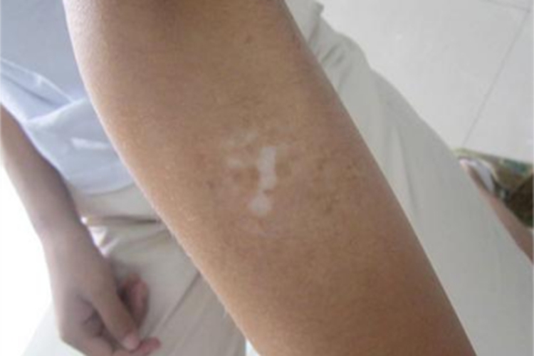 白癜风胳膊白斑图