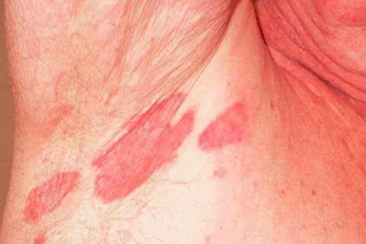 间擦疹腋窝症状图 间擦疹腋窝症状图