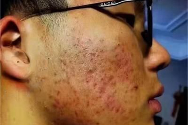 痤疮脸上红肿很多疙瘩图