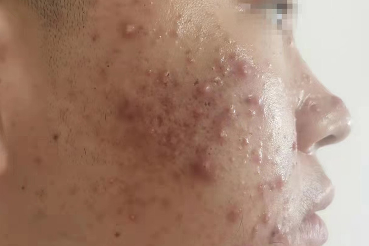 脸上丘疹性痤疮图