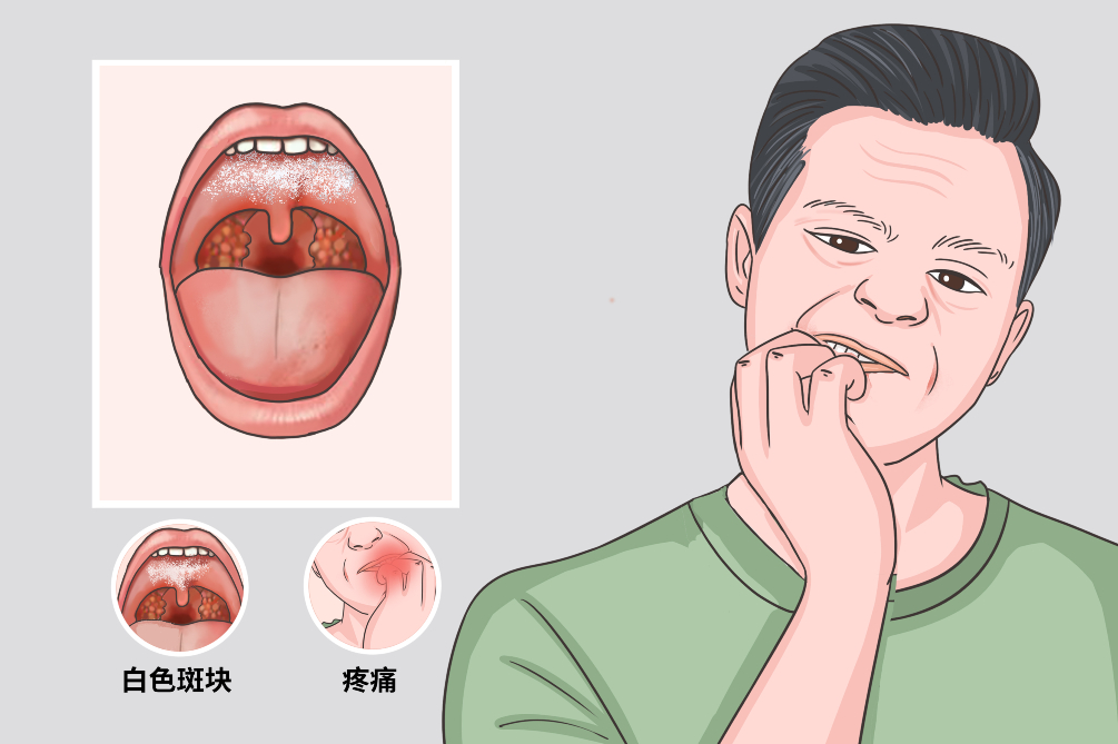 口腔黏膜白斑