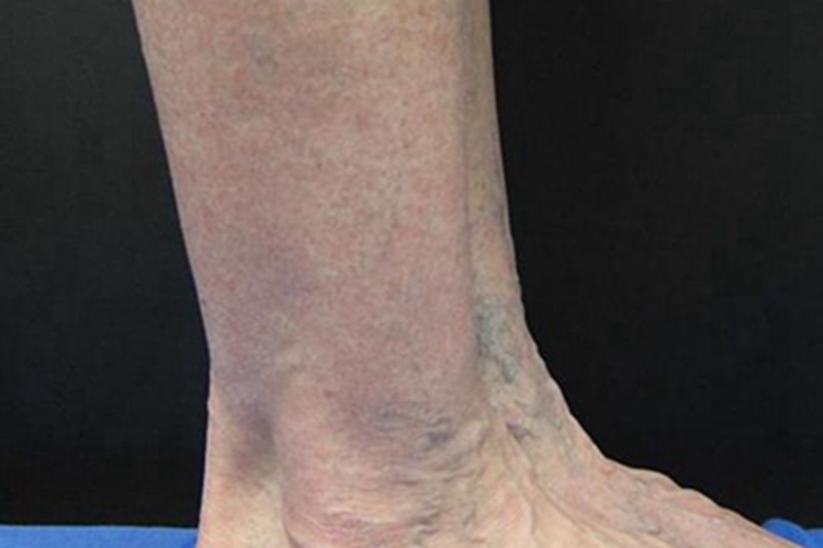 淤积性皮炎脚踝皮肤颜色加深图