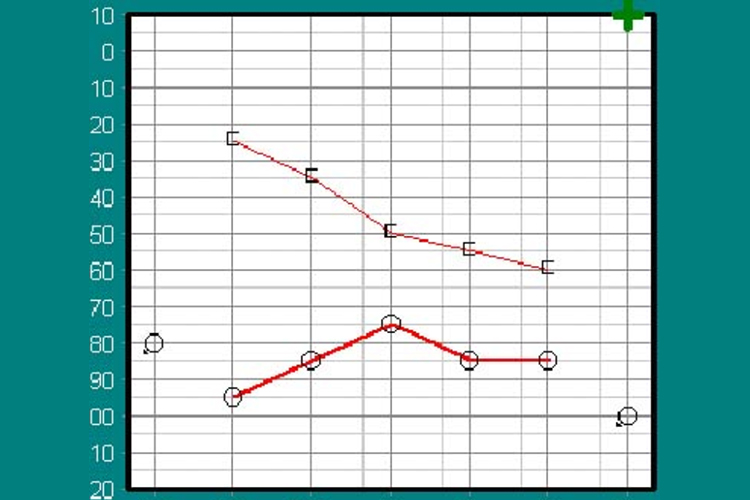 感音性聋听力图