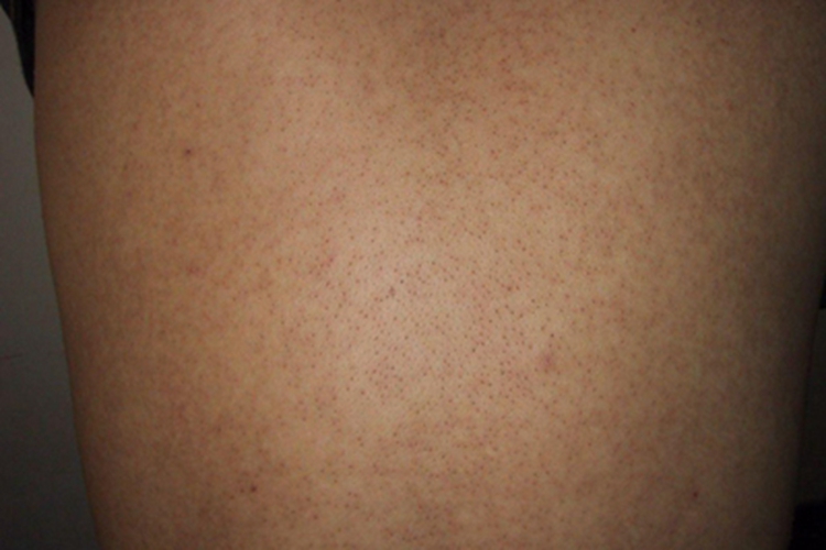 小棘毛壅病背部症状图 小棘毛壅病背部症状图