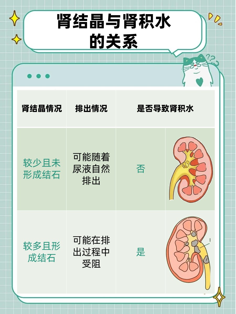 肾结晶会导致肾积水吗？一文解析