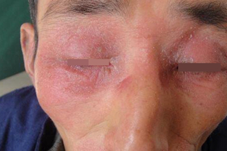 固定型药疹红斑图