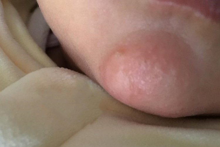 孩子右下巴毛囊炎图 孩子右下巴毛囊炎图