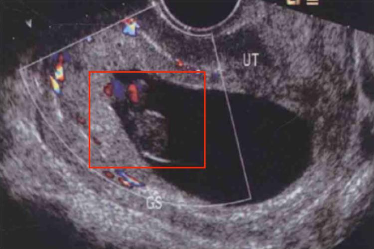 怀孕8周时胚胎B超图