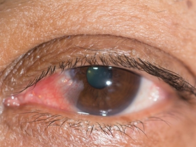 进展期翼状胬肉内眼角眼白上有红斑图