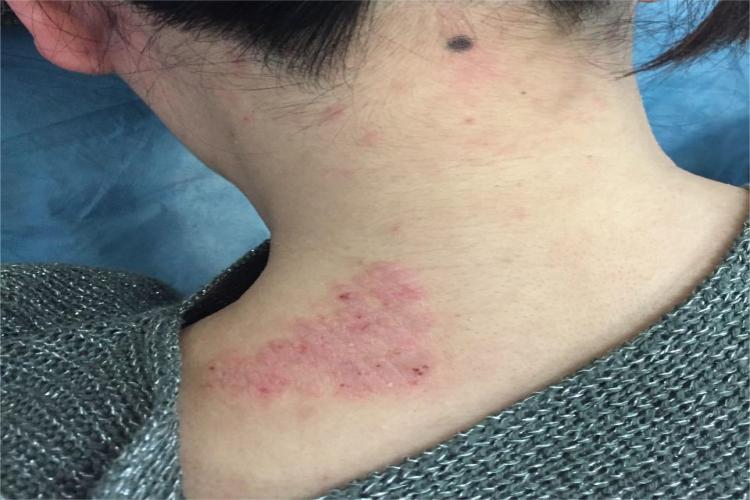 苔藓样型副银屑病颈部血痂图