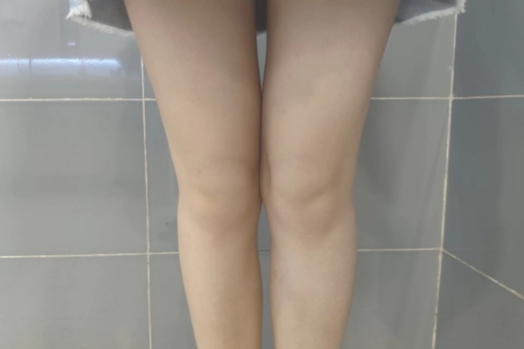 正常膝盖外观图