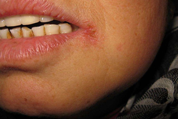 缺铁性贫血皮肤发红图 缺铁性贫血皮肤发红图